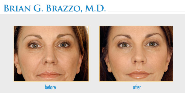 Facial Fillers New York City Dermal Fillers Manhattan Nyc